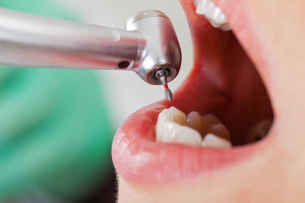 Best Emergency Broken Tooth Repair in Old Jamestown, MO
